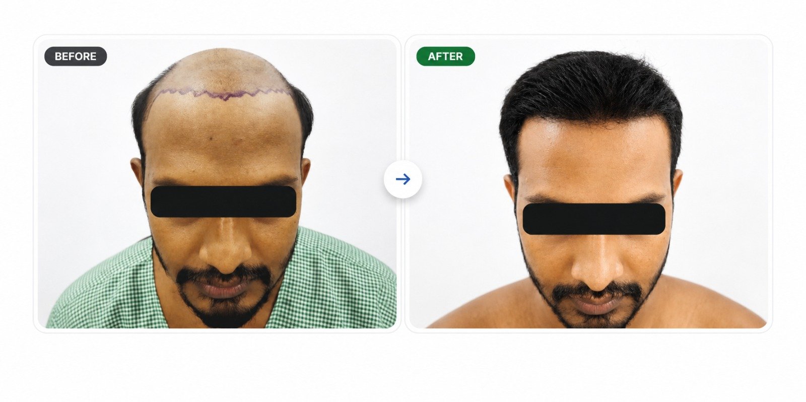 Hair Transplant Before and After - Patient 8